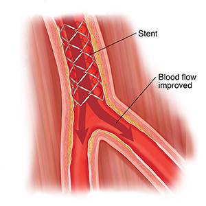 Cross section of peripheral artery with stent.