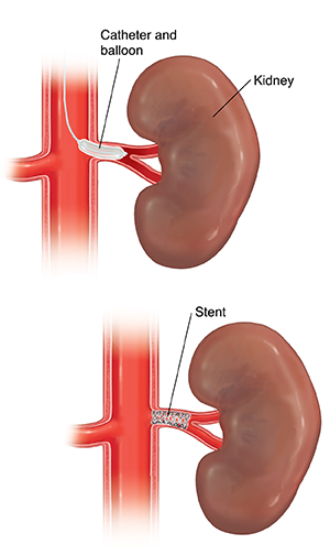 Closeup of kidney showing balloon catheter in renal artery. Closeup of kidney showing stent in renal artery.