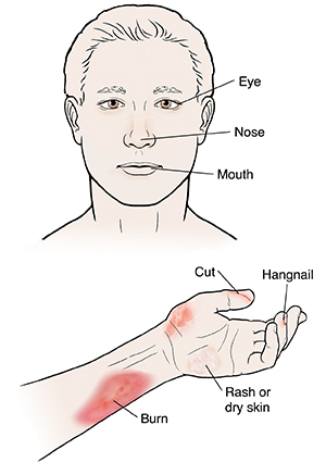 Hand and forearm showing hangnails, cut, burn, rash, and dry skin. Front view of face. 