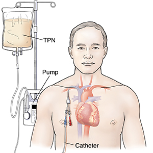 Front view of man showing heart with central line attached to an IV pump.