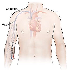 Front view of man's chest showing heart with PICC line in place.