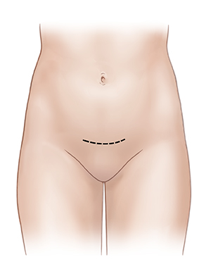 Front view of female abdomen showing low abdominal incision site.
