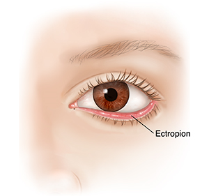 Front view of eye showing drooping lower eyelid and ectropion.