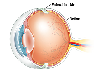Three-quarter view of cross sectioned eye showing scleral buckle around outside of eyeball.