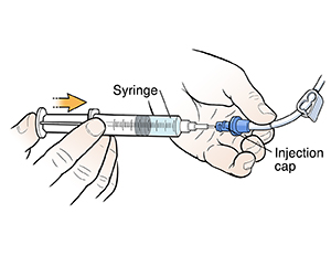 Closeup of hands using syringe to inject solution into catheter injection cap.
