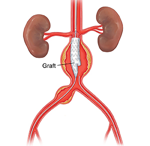 Endovascular procedure to place graft for abdominal aortic aneurysm.