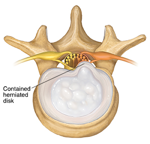 Top view of lumbar vertebra showing contained herniated disk.