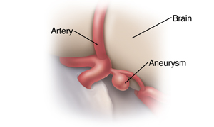 Closeup view of brain aneurysm.