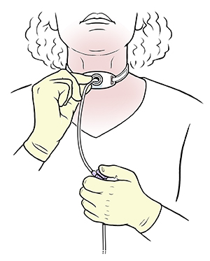 Woman inserting suction catheter into tracheostomy tube in neck.