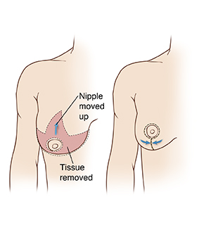 Surgical incisions for reduction mammoplasty. (a) An incision is