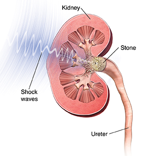 Cross section of kidney showing shock waves breaking up kidney stone.