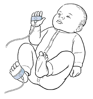 Baby with oxygen sensors wrapped around hand and foot.