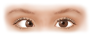 Front view of child’s eyes showing one eye looking straight ahead and one looking towards nose.