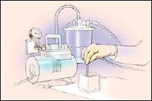 Drawing showing a suction tube suctioning normal saline from a bowl. 