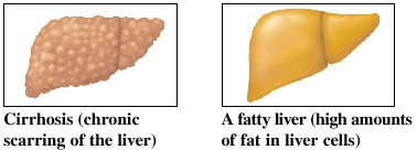 Images of liver with cirrhosis and fatty liver