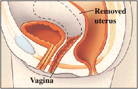 Cutaway view of uterus and vagina