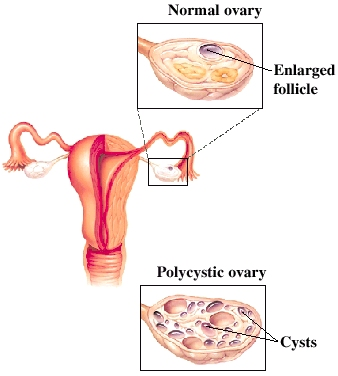Front view of uterus, fallopian tubes, and ovaries. Half of uterus in cross section to show inside. Closeup of normal ovary showing fluid in enlarged follicle. Closeup of polycystic ovary showing many fluid-filled cysts.