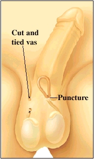 Penis and scrotum with penis pointing up to show underside. Testicles visible in scrotum. Vas on right side is cut and tied above testicle. Loop of vas on left has been brought out through small puncture.