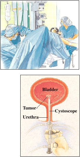 Patient lying on hospital table with legs in stirrups. Healthcare provider is giving patient anesthesia through face mask. Another healthcare provider is sitting between patient's legs with cystoscope. Closeup of cross section of bladder and urethra with cystoscope inserted through urethra into bladder. Instrument in cystoscope is removing tumor from bladder wall.