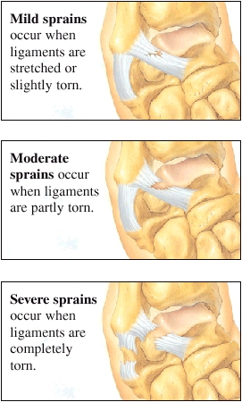 Image of a mild sprain showing a slightly stretched or torn ligament. Image showing moderate sprain with a partly torn ligament. Image showing a severe sprain showing a completely torn ligament.
