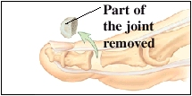 Image of joint removed from toe (arthroplasty)