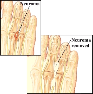 Image of neuroma; and of  neuroma removed