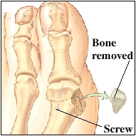 Image of the big toe joint with a piece of bone removed and a scew