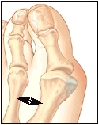 Image of the big toe joint