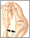 Big toe joint