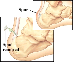 Images of spurs on back of heel and spurs removed