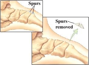 Images of midfoot joint spurs and removal of spurs