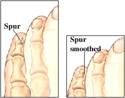 Images of toe spur and spur after being smoothed with a special file
