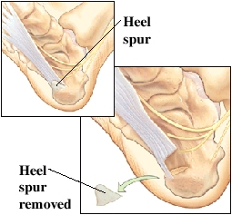Image of heel spur and heel spur removed