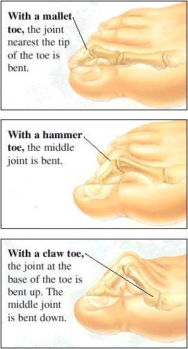Images of a mallet toe, a hammer toe, and a claw toe