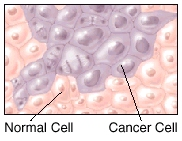 Microscopic view of normal cells and cancer cells.