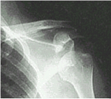 X-ray of dislocated shoulder with bones highlighted in white.