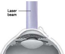 Cross section of eye showing laser beam reshaping cornea under flap.