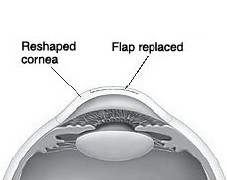 Cross section of eye showing reshaped cornea and flap replaced.