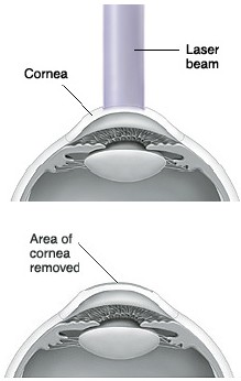 Cross section side view of front of eye showing flap of cornea folded back and laser beam on cornea. Cross section side view of front of cornea showing area of cornea removed by laser.