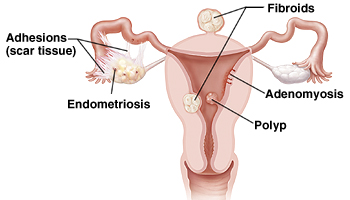 Cross section of uterus, fallopian tubes, and ovaries. Adhesions and endometriosis are on ovaries and tubes. Fibroids are inside uterus and on outside wall of uterus. Adenomyosis and polyps are in uterine lining.