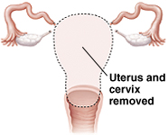 Front view of total hysterectomy showing uterus and cervix removed.