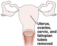 Front view of hysterectomy showing uterus, ovaries, cervix, and fallopian tubes removed.