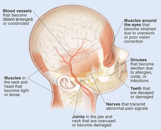 View of side of head slightly from top showing headache causes. Muscles in neck and head become tight or tense. Blood vessels become dilated (enlarged) or constricted. Muscles around eyes become strained due to overwork or poor vision correction. Sinuses become swollen due to allergies, colds, or infections. Teeth are decayed or damaged. Nerves transmit abnormal pain signals. Joints in jaw and neck are overused or become damaged.