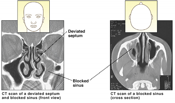 CT scan of deviated septum and blocked sinus (front view). CT scan of blocked sinus (cross section from above).