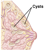 Side cut-away view of a fibrocystic breast