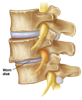 Causes of Lumbar (Low Back) Pain