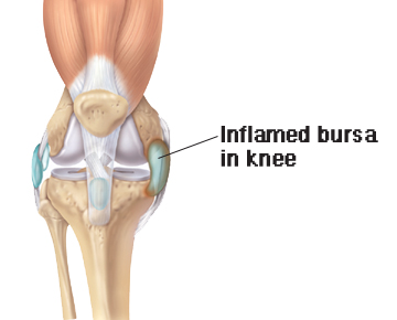 Inflamed bursa in knee