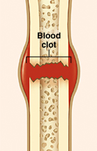 Broken bone showing blood clot forming at break.