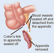 Closeup of colon and appendix showing appendix removed and blood vessels sealed off. Colon's link to appendix is sealed off.
