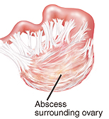 Abcess surrounding ovary